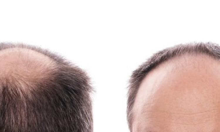 How Dermarollers Can Help Prevent Hair Loss? – MT Dermaroller