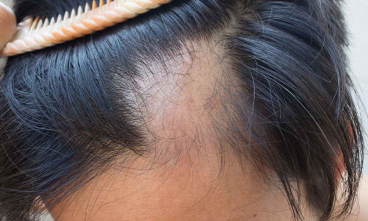 Derma Roller - Hair loss & hair growth therapy –