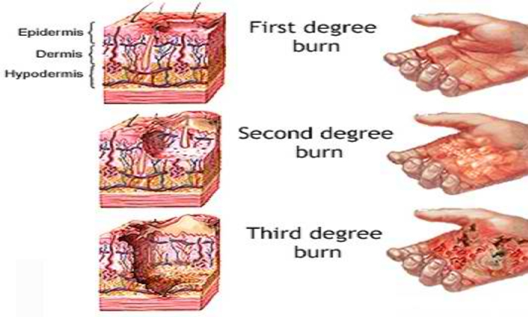 first degree burn healing process